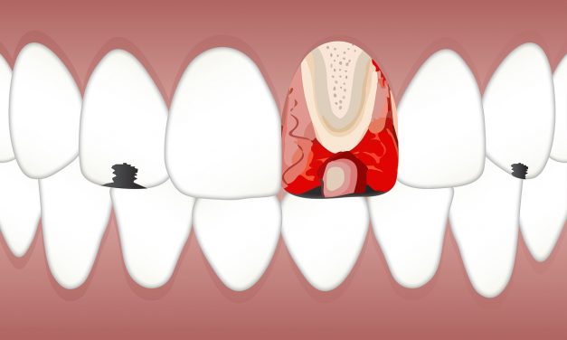 Zapalenie miazgi zęba